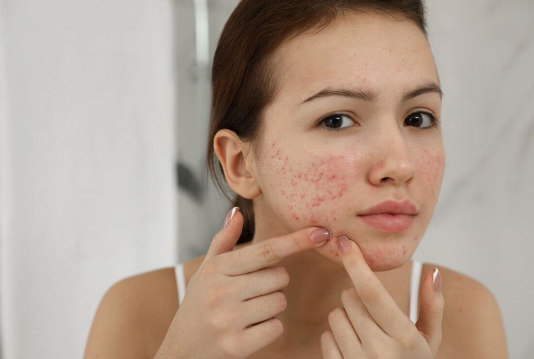 acne giovanile rimedi naturali efficaci